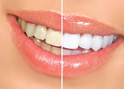 Писалки за избелване на зъбите Dr. Smiles Pop & Prime (5 опаковки)1