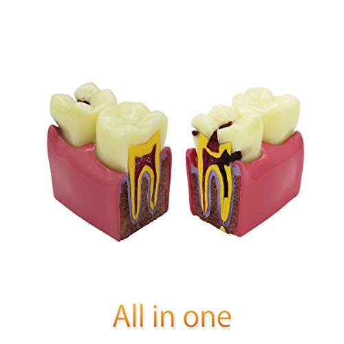 D-CA Стоматологичен Модел на Зъбите, Прозрачен Зъбни Импланти Модел на Зъбите Стандартно Заболяване на Зъболекар Подвижна Зъб